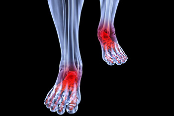 Arthritic foot care in the Middle (Central) Tennessee: Nashville, TN 37211, Smyrna, TN 37167, Spring Hill, TN 37174, Columbia, TN 38401, Dickson, TN 37055, Fairview, TN 37062 and Hohenwald, TN 38462 areas