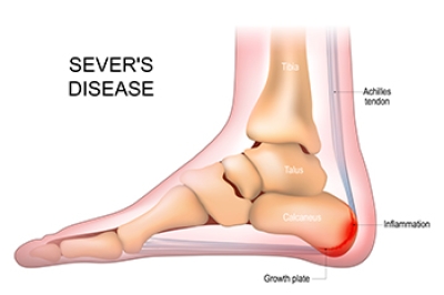 Symptoms and Causes of Sever’s Disease