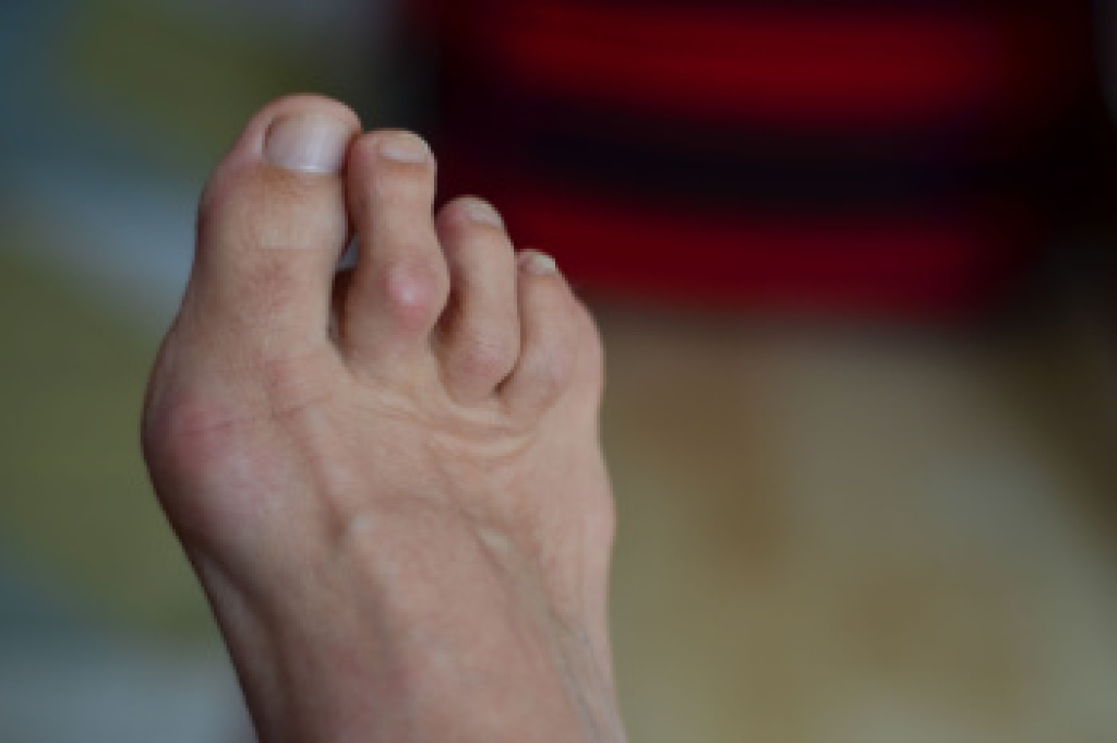 What Causes Hammertoe?