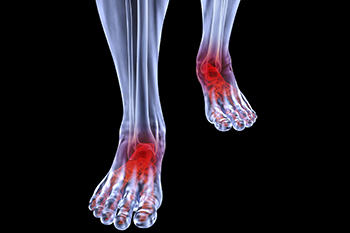 Arthritic foot care in the Middle (Central) Tennessee: Nashville, TN 37211, Smyrna, TN 37167, Spring Hill, TN 37174, Columbia, TN 38401, Dickson, TN 37055, Fairview, TN 37062 and Hohenwald, TN 38462 areas