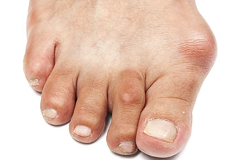 Bunions treatment in the Middle (Central) Tennessee: Nashville, TN 37211, Smyrna, TN 37167, Spring Hill, TN 37174, Columbia, TN 38401, Dickson, TN 37055, Fairview, TN 37062 and Hohenwald, TN 38462 areas