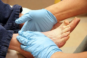 Diabetic foot treatment in the Middle (Central) Tennessee: Nashville, TN 37211, Smyrna, TN 37167, Spring Hill, TN 37174, Columbia, TN 38401, Dickson, TN 37055, Fairview, TN 37062 and Hohenwald, TN 38462 areas
