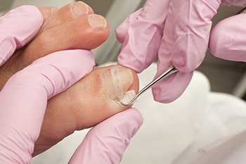 Ingrown toenail treatment in the Middle (Central) Tennessee: Nashville, TN 37211, Smyrna, TN 37167, Spring Hill, TN 37174, Columbia, TN 38401, Dickson, TN 37055, Fairview, TN 37062 and Hohenwald, TN 38462 areas