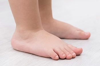 overpronation