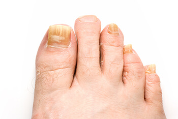 Toenail fungus treatment in the Middle (Central) Tennessee: Nashville, TN 37211, Smyrna, TN 37167, Spring Hill, TN 37174, Columbia, TN 38401, Dickson, TN 37055, Fairview, TN 37062 and Hohenwald, TN 38462 areas