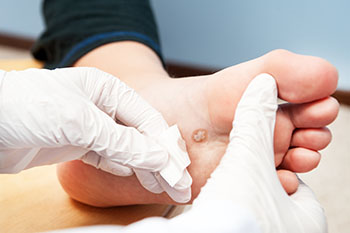 Warts treatment in the Middle (Central) Tennessee: Nashville, TN 37211, Smyrna, TN 37167, Spring Hill, TN 37174, Columbia, TN 38401, Dickson, TN 37055, Fairview, TN 37062 and Hohenwald, TN 38462 areas