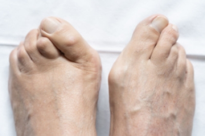 What to Know About Bunions
